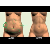 cirurgia para dermolipectomia barriga Tijucas do Sul