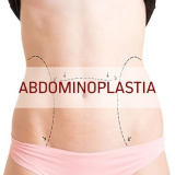 cirurgia para dermolipectomia do abdomen Campo Largo