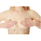 cirurgia plástica de mama preço Tijucas do Sul