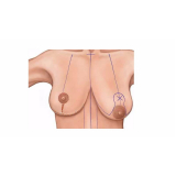 cirurgia plástica de mamoplastia preço São José dos Pinhais