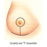 mamoplastia redutora com prótese de silicone Itaperuçu