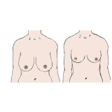 mamoplastia redutora Vila Izabel