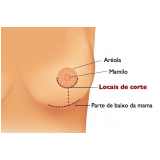 onde encontro clínica de mamoplastia em Curitiba Almirante Tamandaré